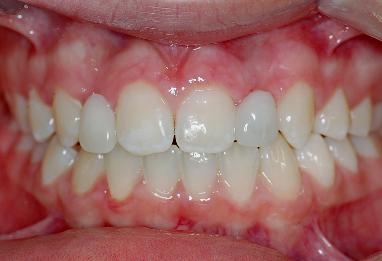 Semipermanent replacement of missing maxillary lateral incisors with